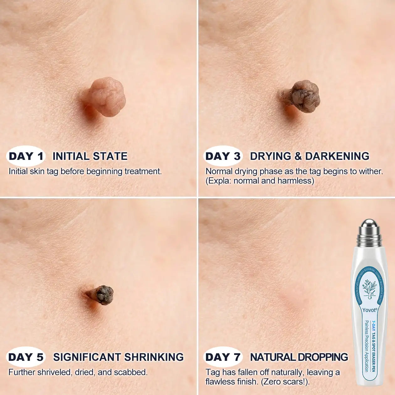 𝐘𝐨𝐯𝐨𝐭®🩹🎉7-𝐷𝑎𝑦 𝗧𝐚𝐠 & 𝗦𝗽𝐨𝐭 𝐄𝐫𝒂𝒔𝒆𝒓(Zero Pain. Zero 𝐒𝐜𝐚𝒓𝒔 Rollerball)