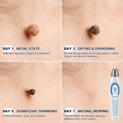 𝐘𝐨𝐯𝐨𝐭®🩹🎉7-𝐷𝑎𝑦 𝗧𝐚𝐠 & 𝗦𝗽𝐨𝐭 𝐄𝐫𝒂𝒔𝒆𝒓(Zero Pain. Zero 𝐒𝐜𝐚𝒓𝒔 Rollerball)